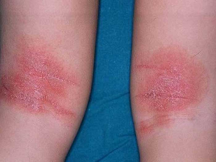 Atopic Dermatitis