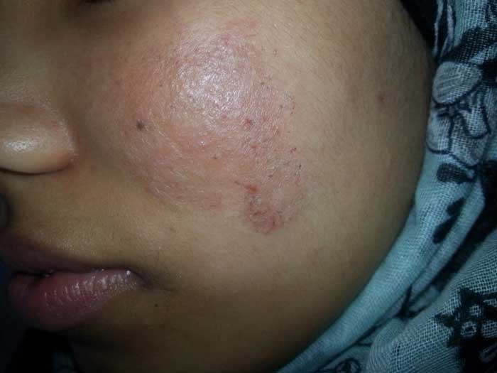 Atopic Dermatitis