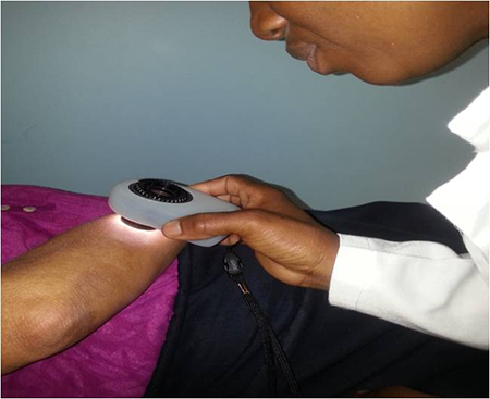Dermatoscope