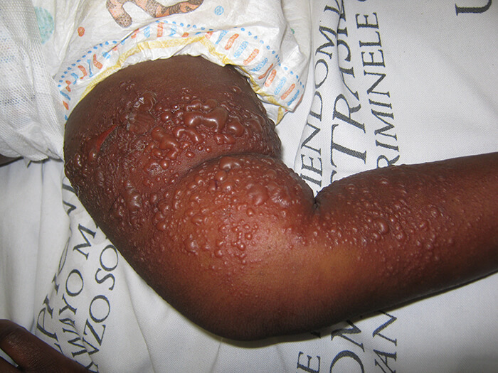 Other Forms of Dermatitis