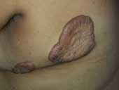 Intralesional Steroid Injections