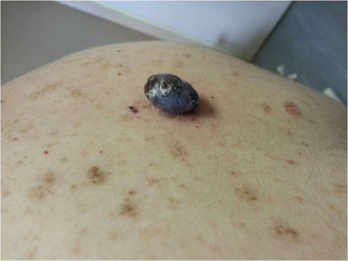 Malignant Tumours