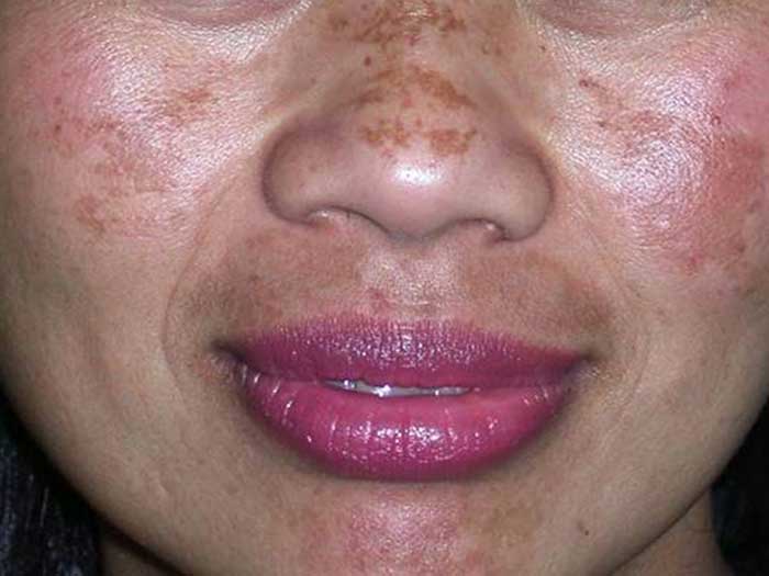 Pigmentation Disorders
