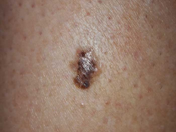 Mole Mapping