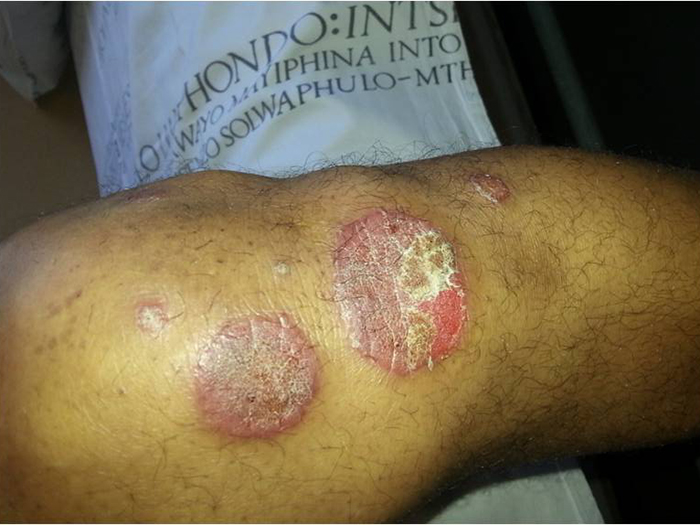 Psoriasis