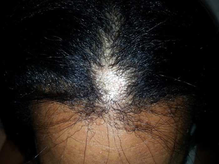 Hair Disorder