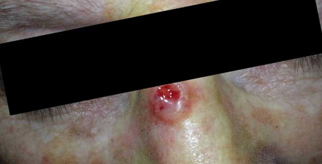 Malignant Tumours
