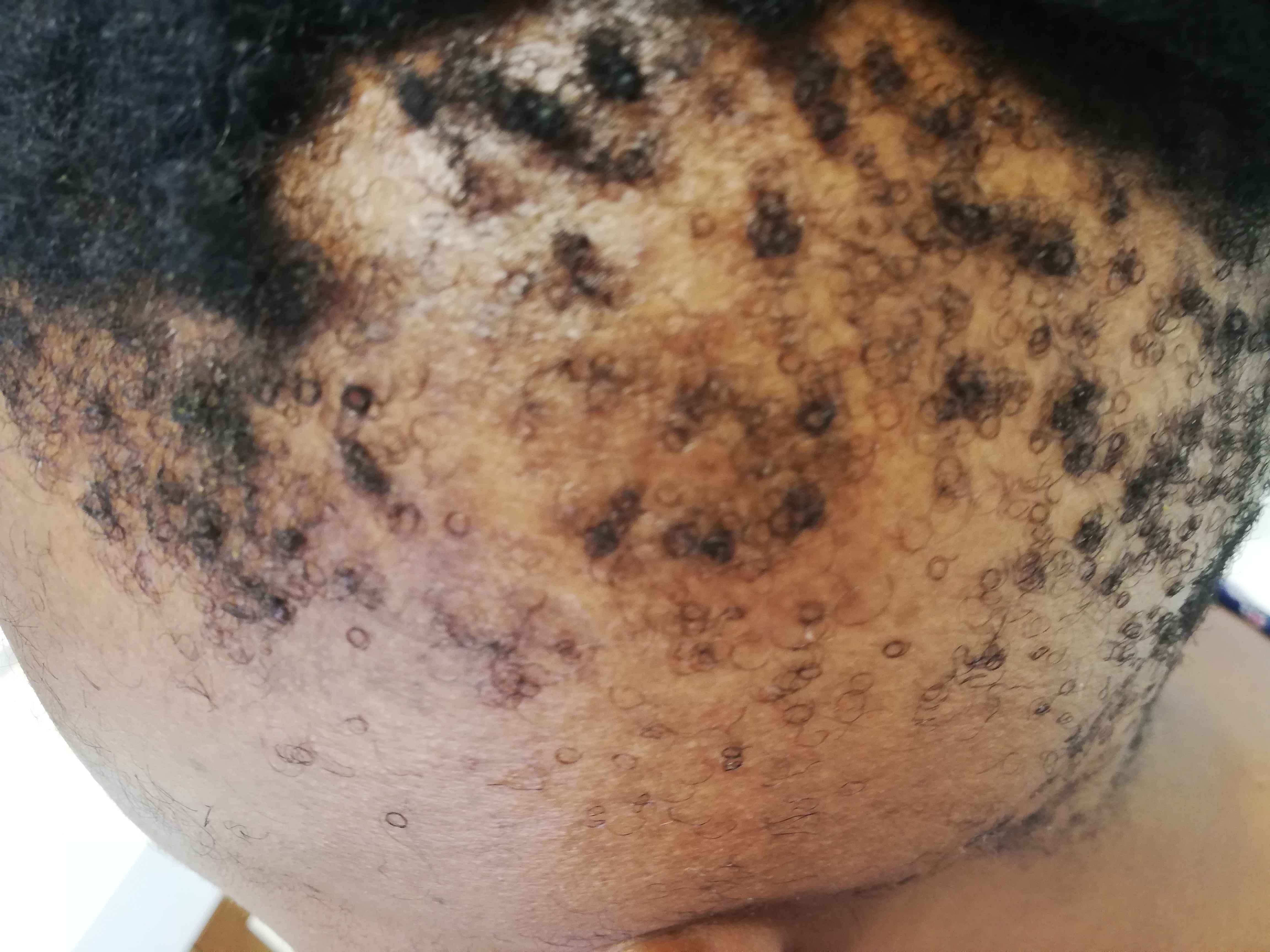 Alopecia 1