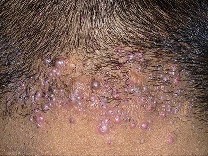 Acne Keloidalis Nuchae