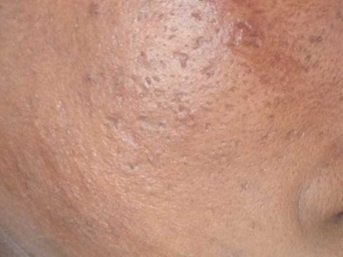 Acne Scarring 1
