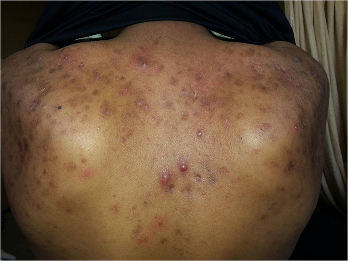 Acne Vulgaris 2