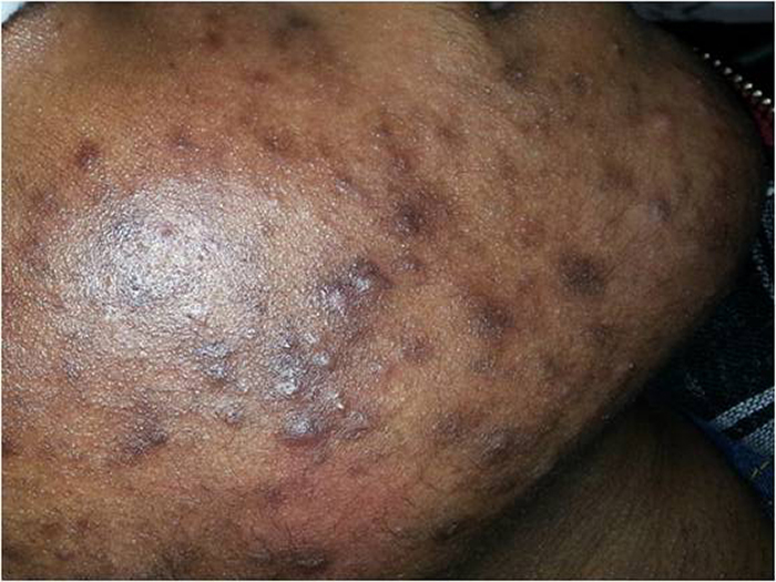 Acne Vulgaris 3