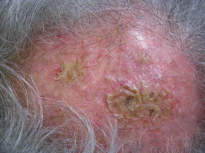 Actinic Keratosis