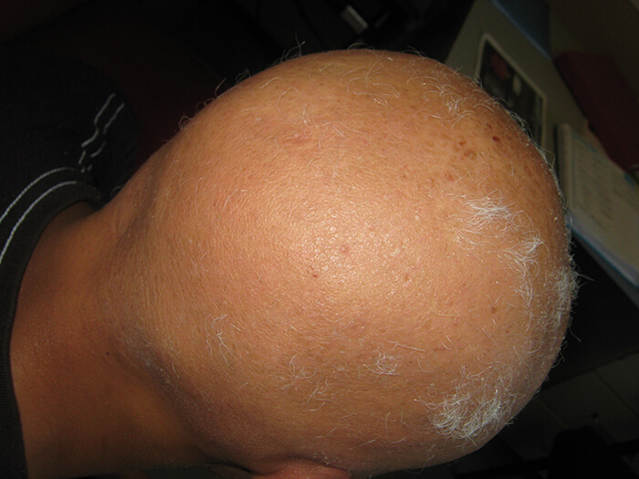 Alopecia Areata