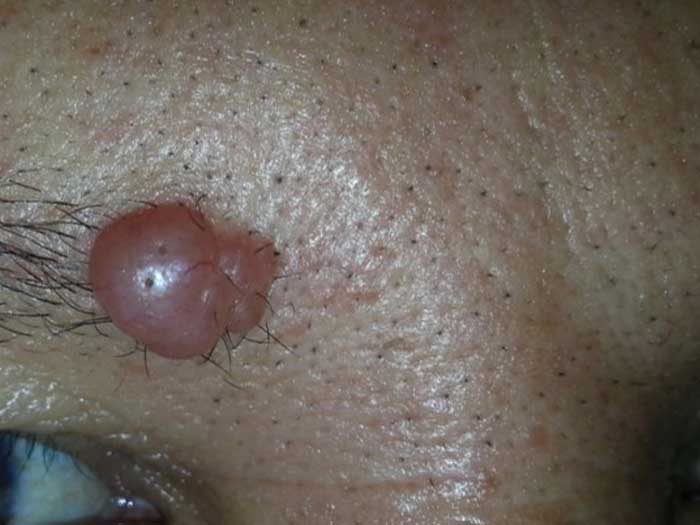 Apocrine Cystadenoma 2