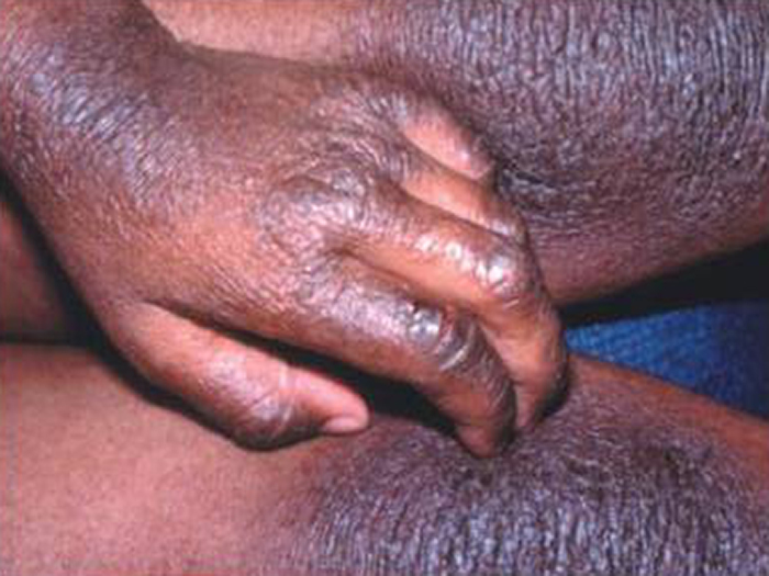 Atopic Dermatitis 1