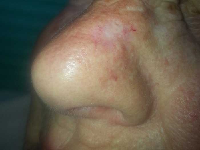 Basal Cell Carcinoma
