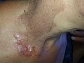 Dermatofibrosarcoma Protuberans Tiny