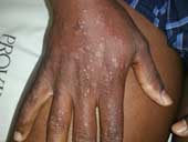 Erythema Multiforme Tiny