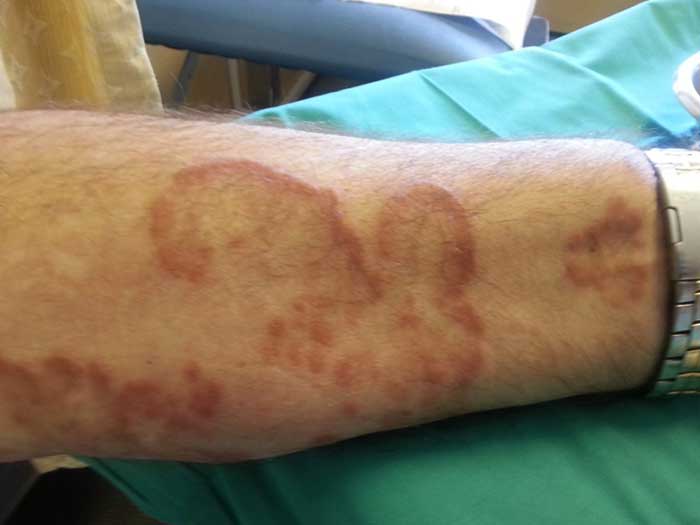 Fungal Infection