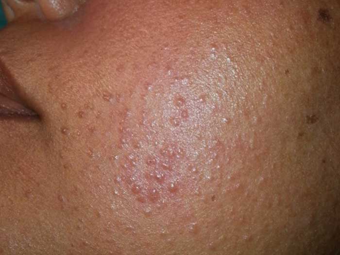 Granuloma Annulare