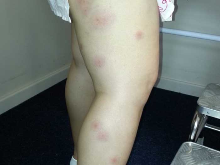 Insects Bites