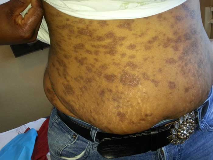 Lichen Planus