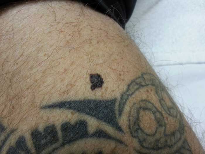 Malignant Melanoma 2