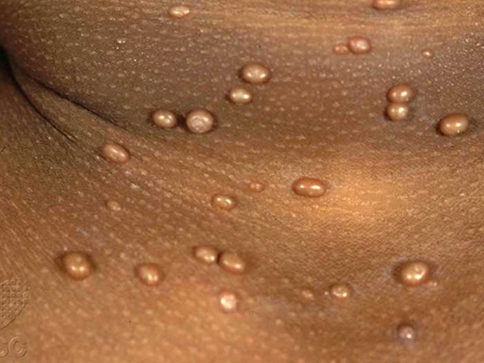Molluscum Contagiosum