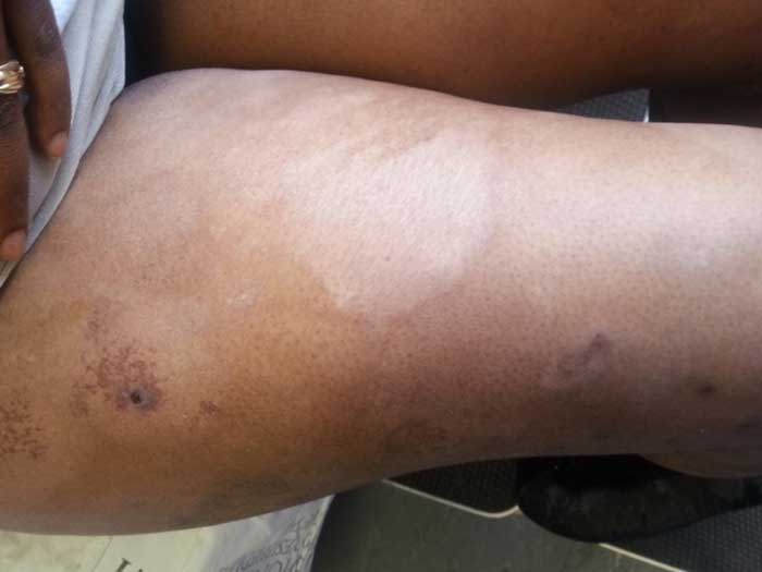 Mycosis Fungoides