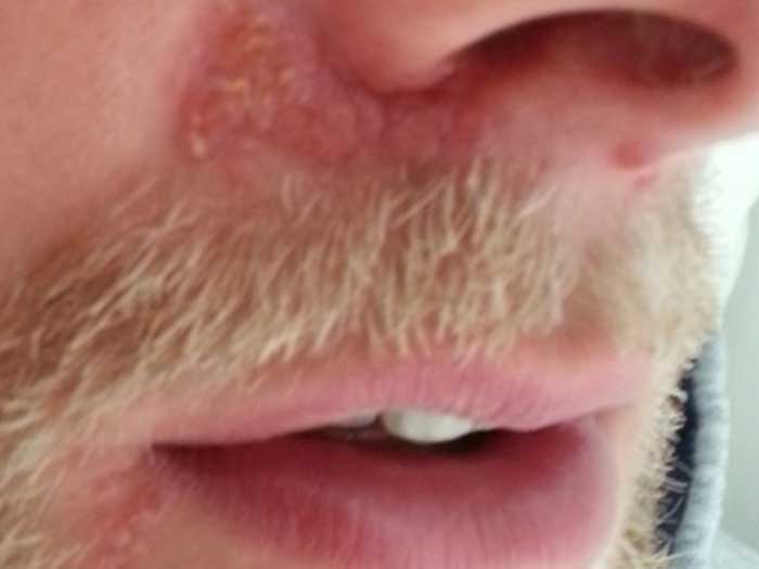 Perioral Dermatitis