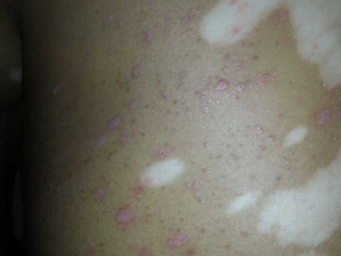 Pigmentation Disorders