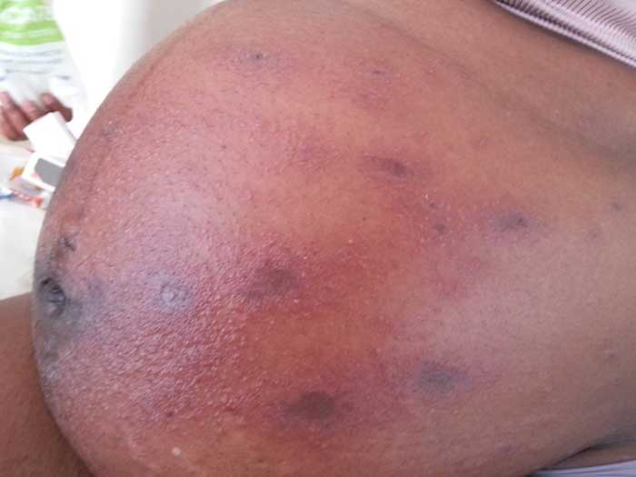 Pregnancy Associated Dermatitis