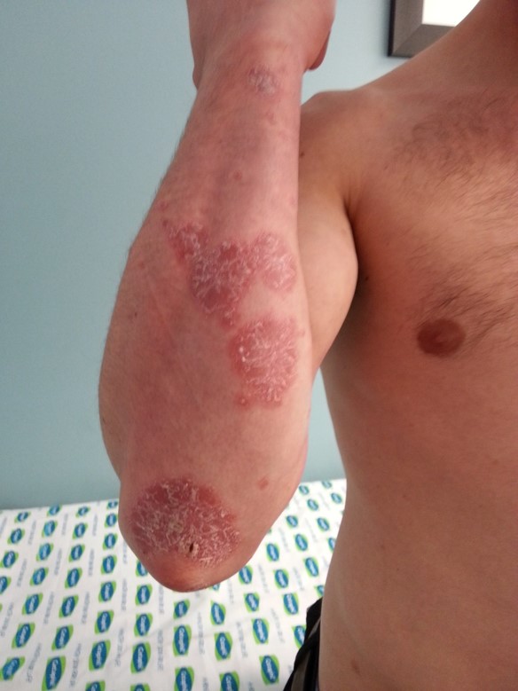 Psoriasis 3