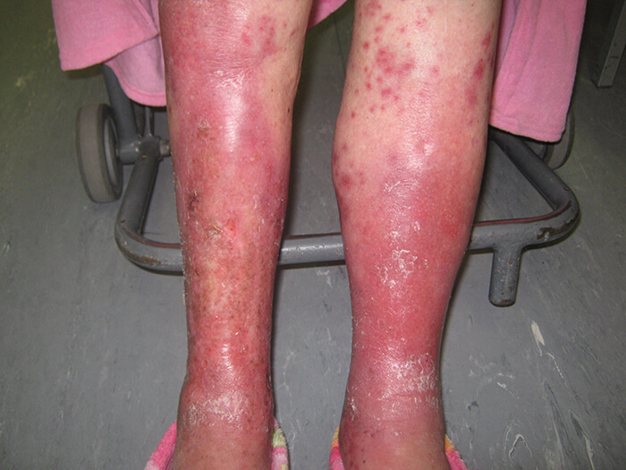 Psoriasis