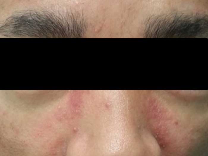 Rosacea