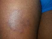 Sarcoidosis Tiny