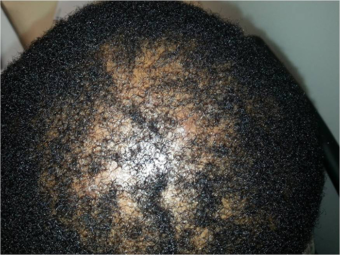 Scarring Alopecia
