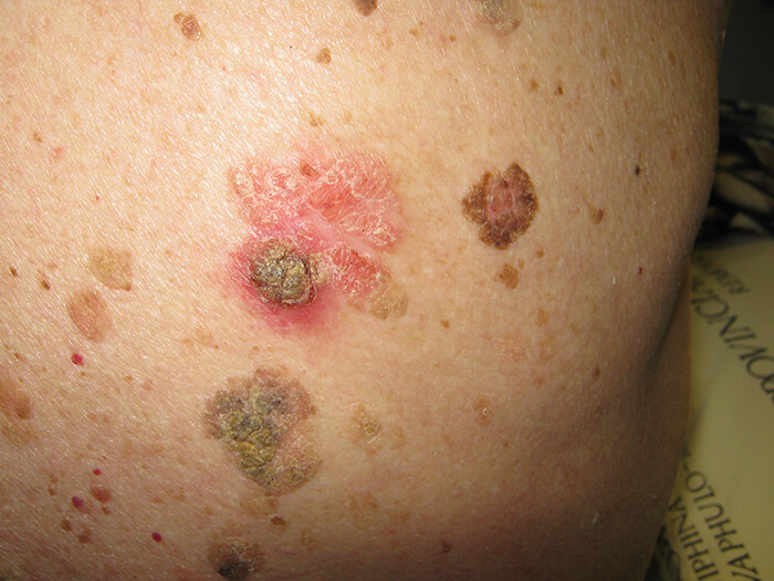 Seborrheic Keratosis