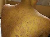 Secondary Syphilis Tiny