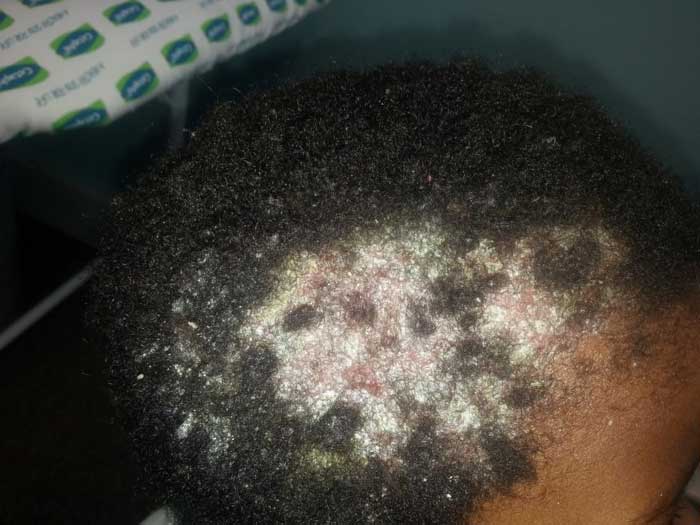 Tinea Capitis 2