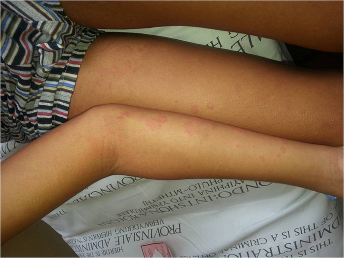 Urticaria 2