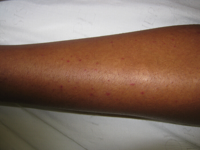 Vasculitis 2