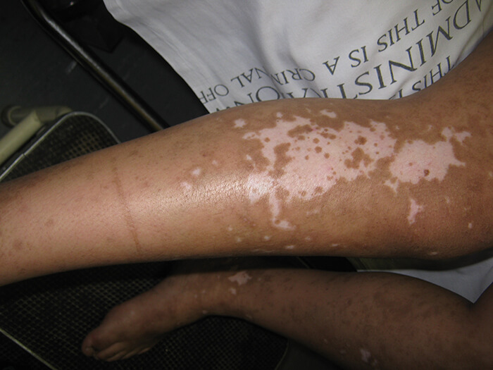 Vitiligo