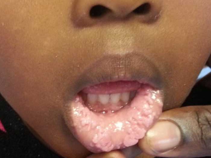 Warts Hecks Disease