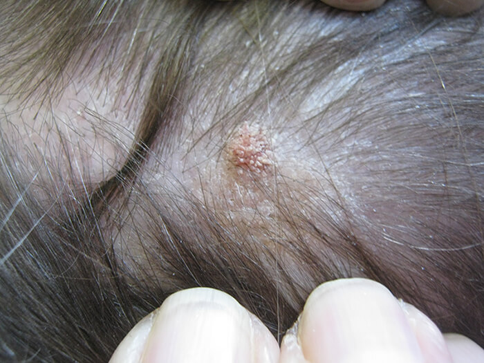Warts